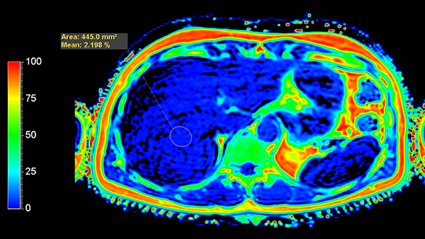 Axial mDIXON Quant (Fat Fraction)